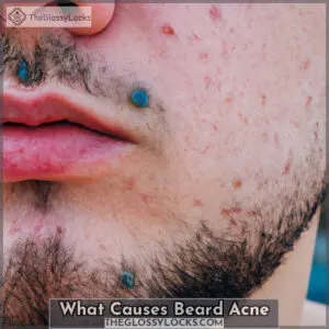 what causes beard acne