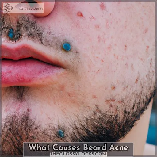 What Causes Beard Acne?