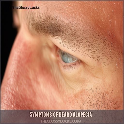 Symptoms of Beard Alopecia