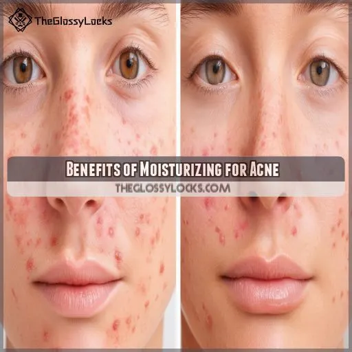 Benefits of Moisturizing for Acne