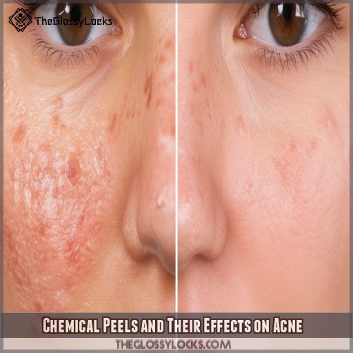 Chemical Peels and Their Effects on Acne