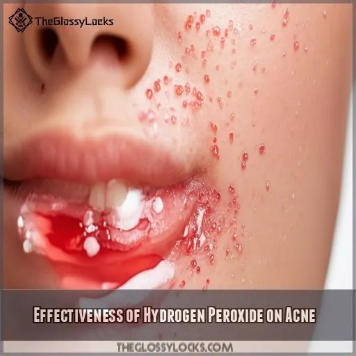 Effectiveness of Hydrogen Peroxide on Acne