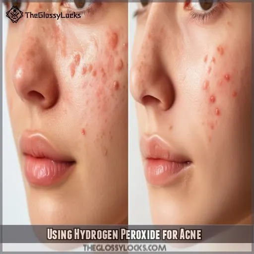 Using Hydrogen Peroxide for Acne