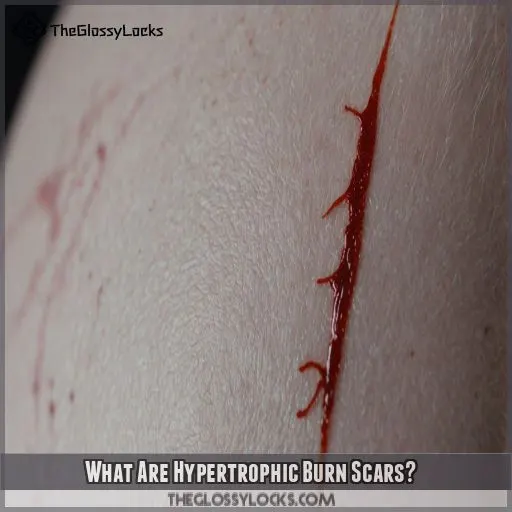 What Are Hypertrophic Burn Scars