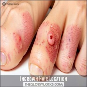 Ingrown Hair Location