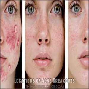 Locations of Acne Breakouts