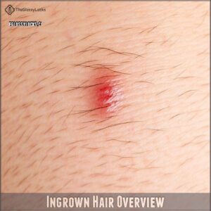 Ingrown Hair Overview