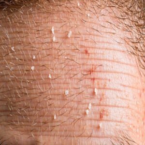 Flaking, Redness, and Itching on The Scalp