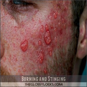 Burning and Stinging