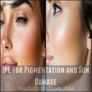 IPL for Pigmentation and Sun Damage