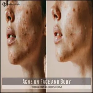 Acne on Face and Body