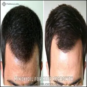 Minoxidil for Hair Regrowth