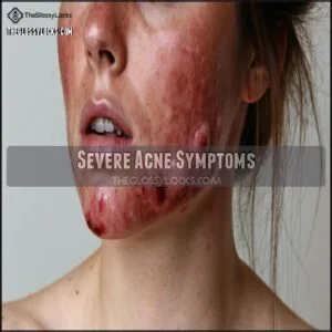 Severe Acne Symptoms