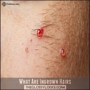 What Are Ingrown Hairs