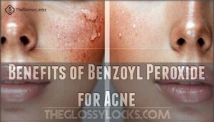 benefits of benzoyl peroxide for acne
