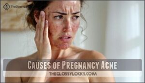 causes of pregnancy acne