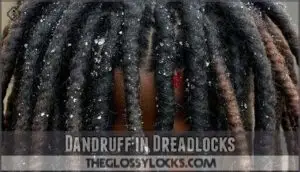 dandruff in dreadlocks