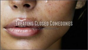 treating closed comedones