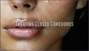 treating closed comedones
