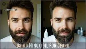 using minoxidil for beard