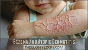 eczema and atopic dermatitis