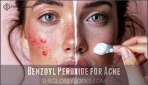benzoyl peroxide for acne