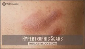 hypertrophic scars