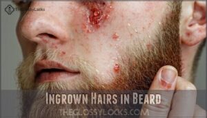 ingrown hairs in beard