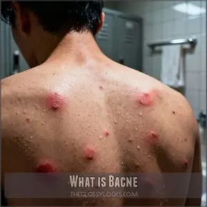 what is bacne what is bacne
