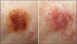 distinguishing burn scars from other marks distinguishing burn scars from other marks