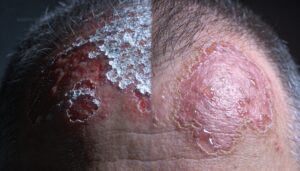 psoriasis and atopic dermatitis psoriasis and atopic dermatitis