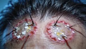 tinea capitis and scalp infections tinea capitis and scalp infections