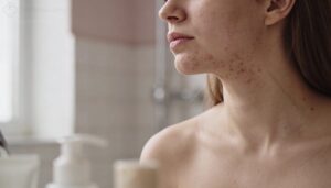 what is hormonal acne and who gets it what is hormonal acne and who gets it
