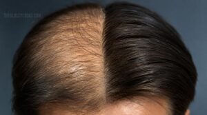 increased scalp coverage over time increased scalp coverage over time