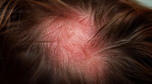scalp conditions that cause hair loss scalp conditions that cause hair loss