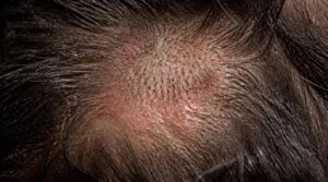 tinea capitis ringworm tinea capitis ringworm