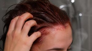 why your scalp itches after dyeing why your scalp itches after dyeing