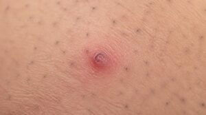 how to identify ingrown hairs how to identify ingrown hairs