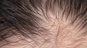 typical scalp hair distribution typical scalp hair distribution