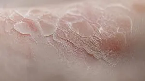 why damaged skin starts flaking why damaged skin starts flaking