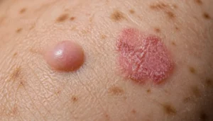 pearly bumps and scaly patches pearly bumps and scaly patches