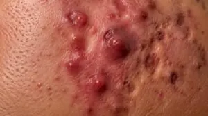 progression and scarring risks progression and scarring risks